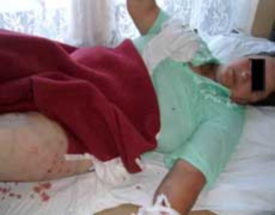 Femeie din Cacica, desfigurată de cîinele ciobănesc al vecinilor Femeie din Cacica, desfigurată de cîinele ciobănesc al vecinilor