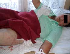 Femeie din Cacica, desfigurată de cîinele ciobănesc al vecinilor