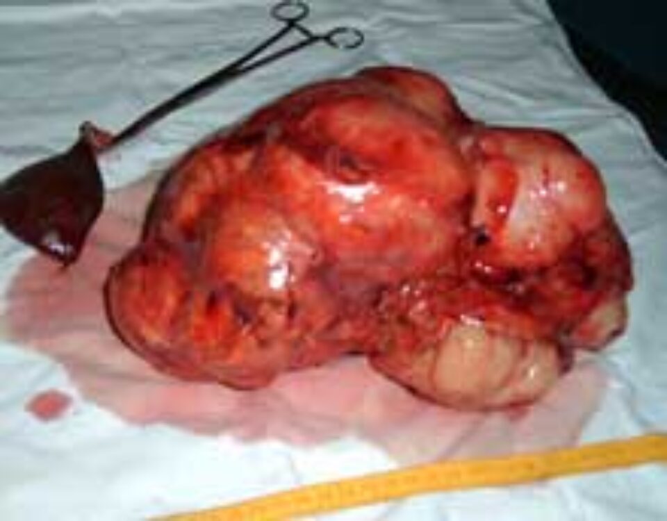 Urologii suceveni au extirpat o tumoră renală uriașă, în greutate de 4 kilograme