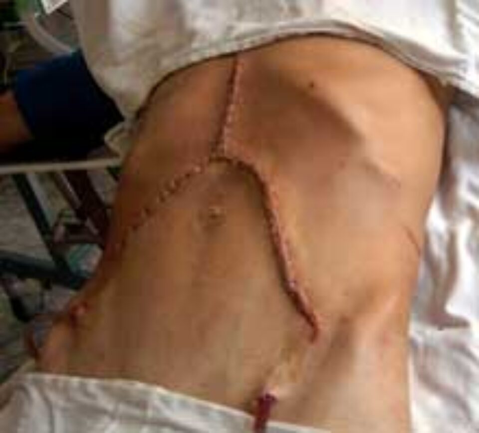 Urologii suceveni au extirpat o tumoră renală uriașă, în greutate de 4 kilograme