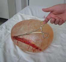 Chirurgii suceveni au operat o tumoră gigant de 6 kilograme