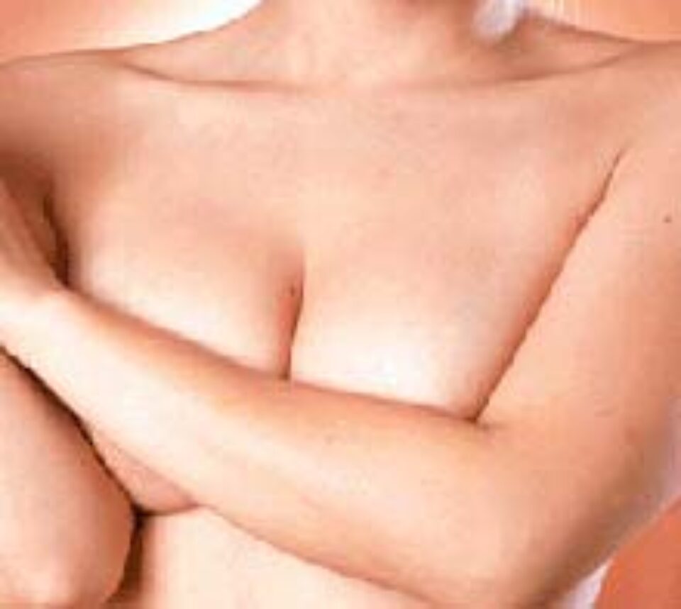 Sâni modelați tehnologic Sâni modelați tehnologic