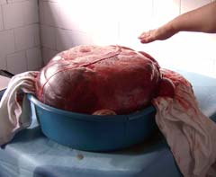 Chirurgii suceveni au extirpat o tumoră gigant de 30 de kilograme