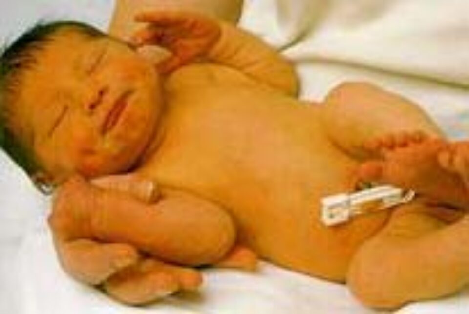 Copiii născuți prin cezariană sunt privați de o etapă importantă în dezvoltarea sistemului imunitar Copiii născuți prin cezariană sunt privați de o etapă importantă în dezvoltarea sistemului imunitar