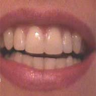 Durerile de dinți - măsuri profilactice