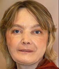 Prima grefă de față din lume, o reușită din punct de vedere estetic