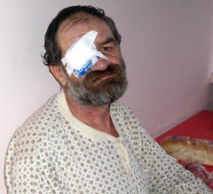 Aurel Aştefănoaie riscă acum să rămână fără ochiul drept