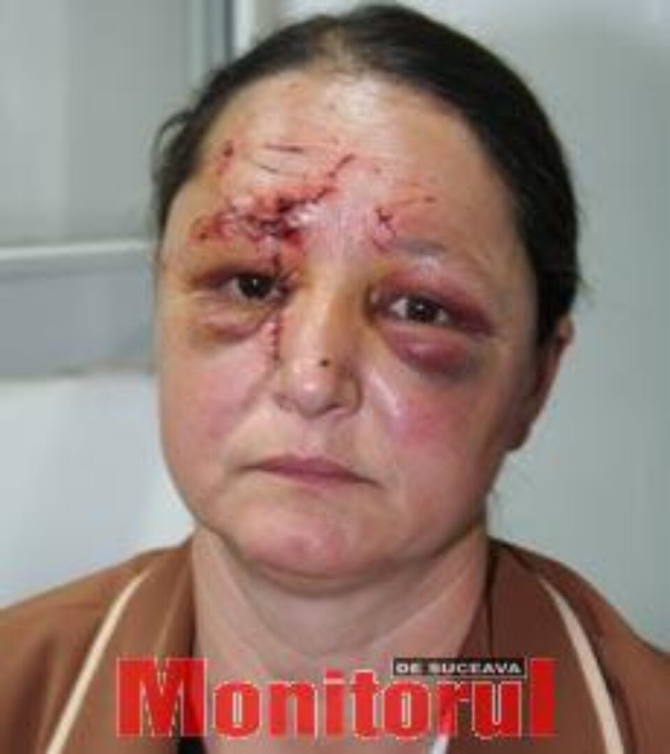 Femeie din Moara, desfigurată de cumnat
