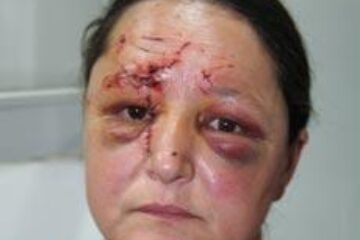 Femeie din Moara, desfigurată de cumnat