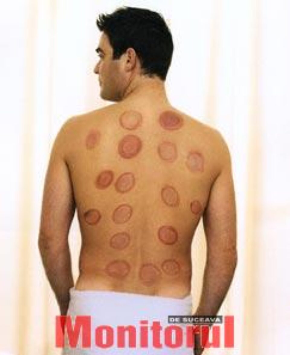 Spondilita anchilozantă apare mai des la tineri