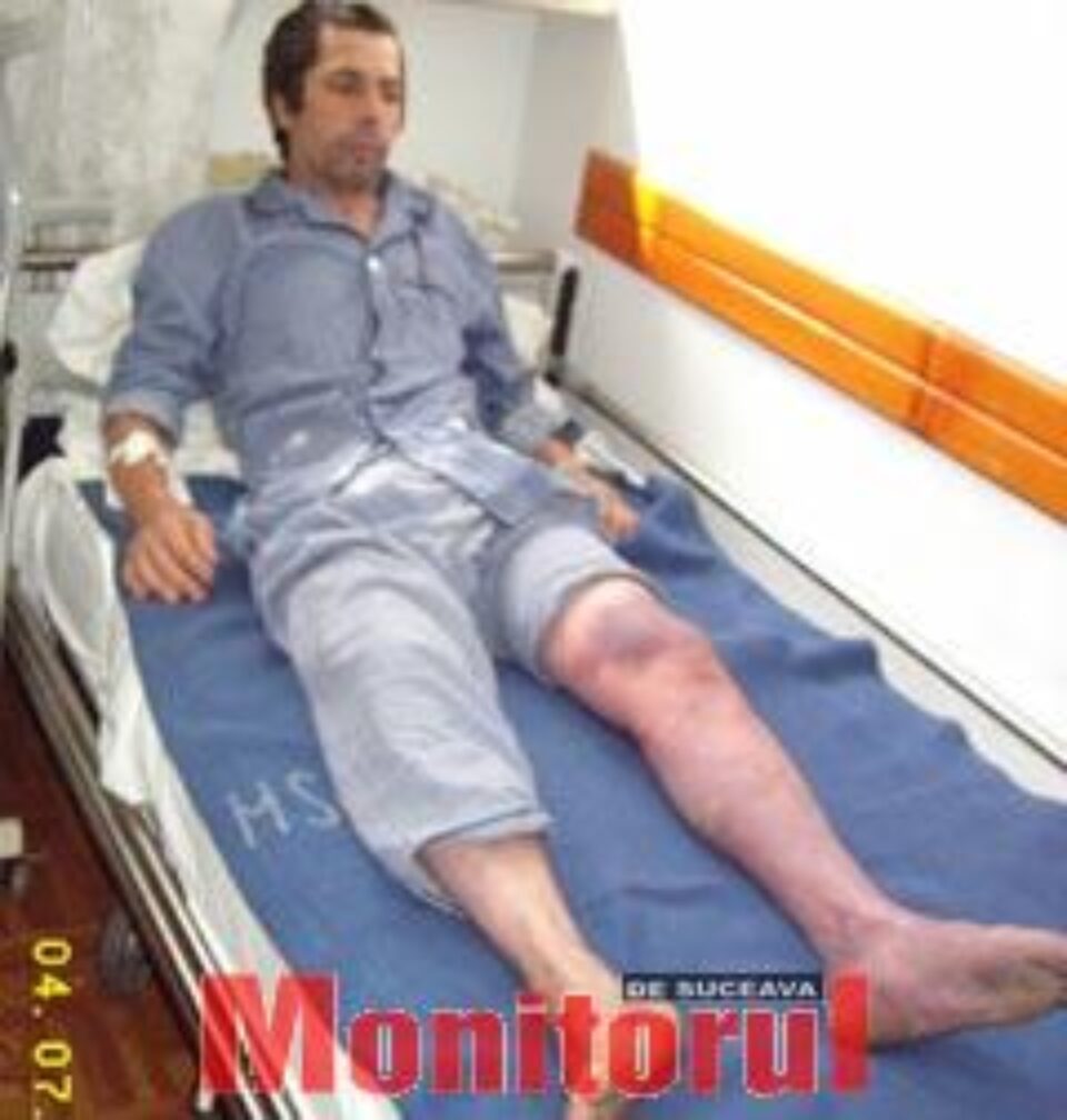 Colegiul Medicilor a demarat o anchetă în cazul pacientului rămas fără un picior