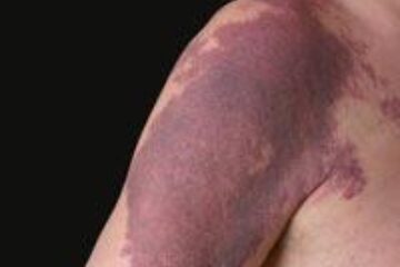 Cancerul de piele, provocat de o genă