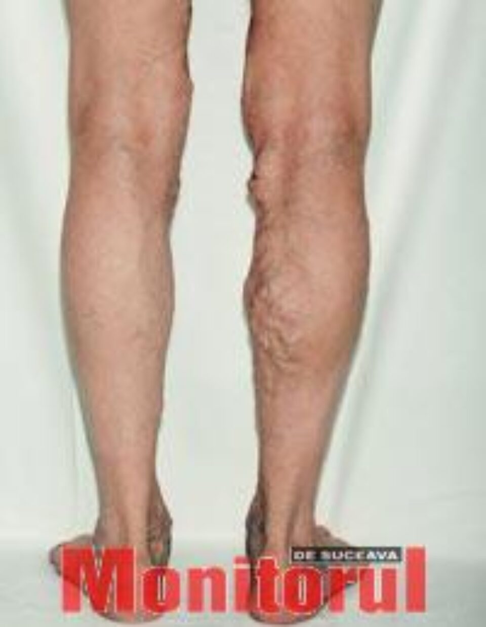 Varicele: mai bine previi decât să te operezi