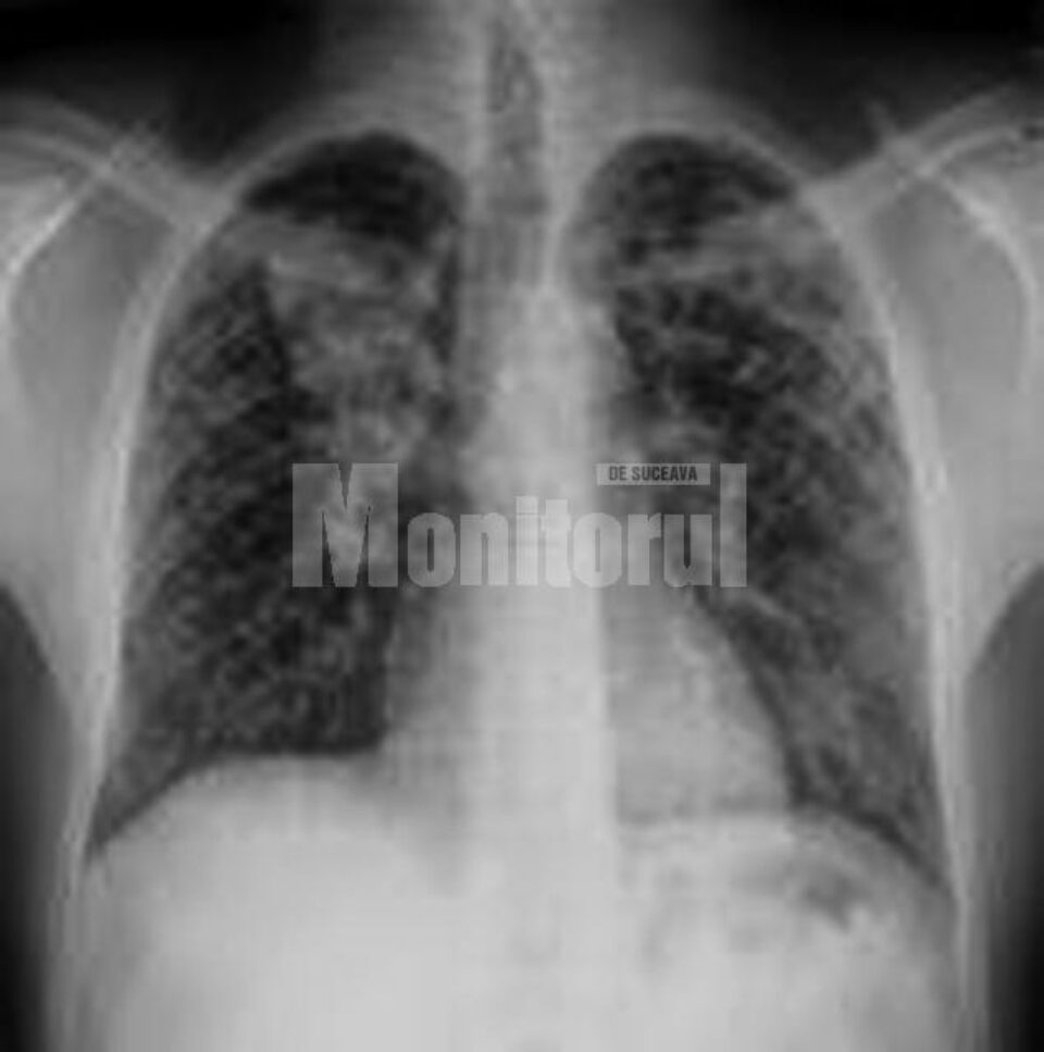 Date oficiale: Mai puțini suceveni bolnavi de TBC, sifilis și gonoree