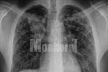 Date oficiale: Mai puțini suceveni bolnavi de TBC, sifilis și gonoree