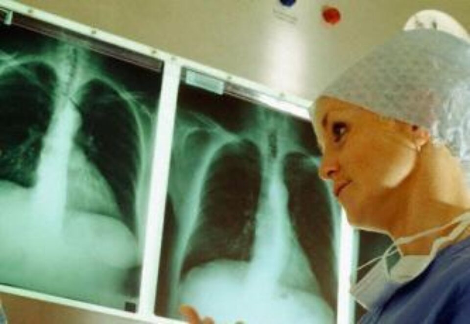 În prezent medicina nu prea reușește să combată cancerul pulmonar. Foto: CORBIS