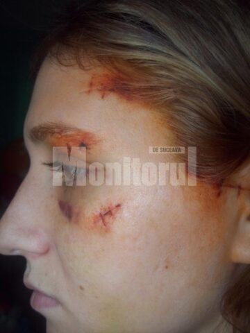 Pentru leziunile suferite, legiștii au stabilit ca are nevoie între 18 si 19 zile de îngrijiri medicale