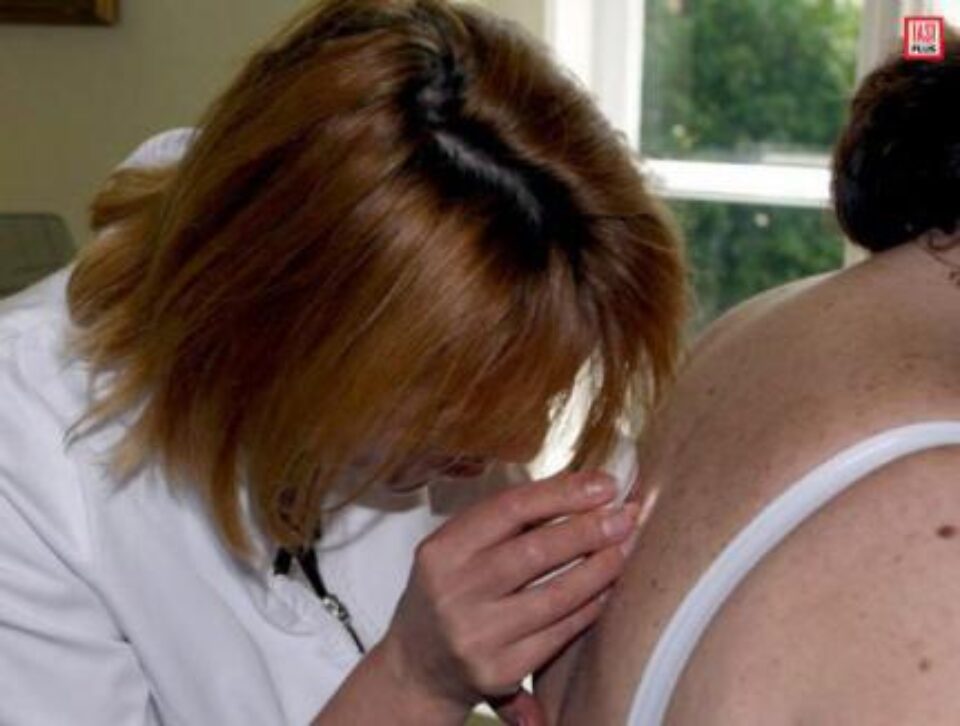 Între alunițe și cancerul de piele există o legătură directă