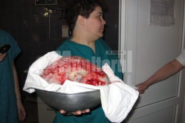 La extirparea tumorilor uriașe, există multe riscuri pentru pacient