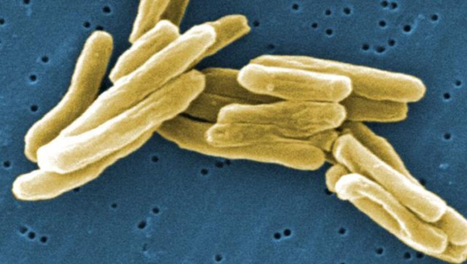 Test pentru diagnosticarea tuberculozei în două ore, descoperit de cercetători Test pentru diagnosticarea tuberculozei în două ore, descoperit de cercetători