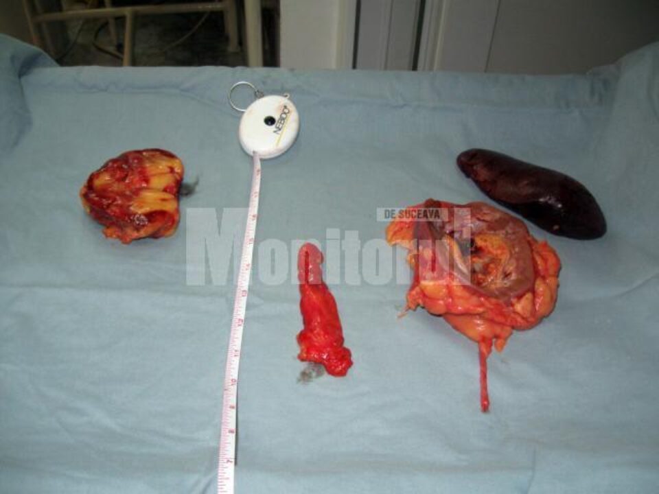 Echipa de medici a extirpat, în cadrul unei singure operații, două tumori care s-au dezvoltat în același timp