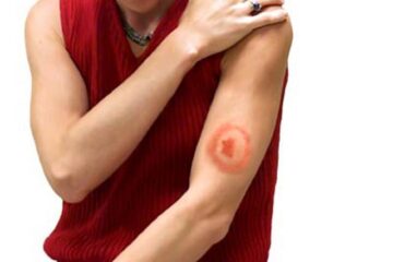 Numărul sucevenilor bolnavi sau suspecți de boala Lyme, în creștere. Foto: what-is-lyme-disease.com
