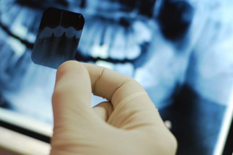 Radiografiile dentare pot cauza tumori cerebrale