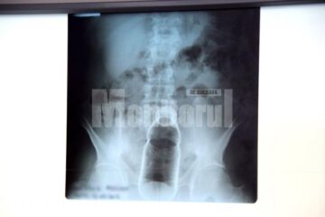 Un botoșănean de 46 de ani a ajuns la Spitalul Județean Suceava după ce și-a băgat o sticlă în anus