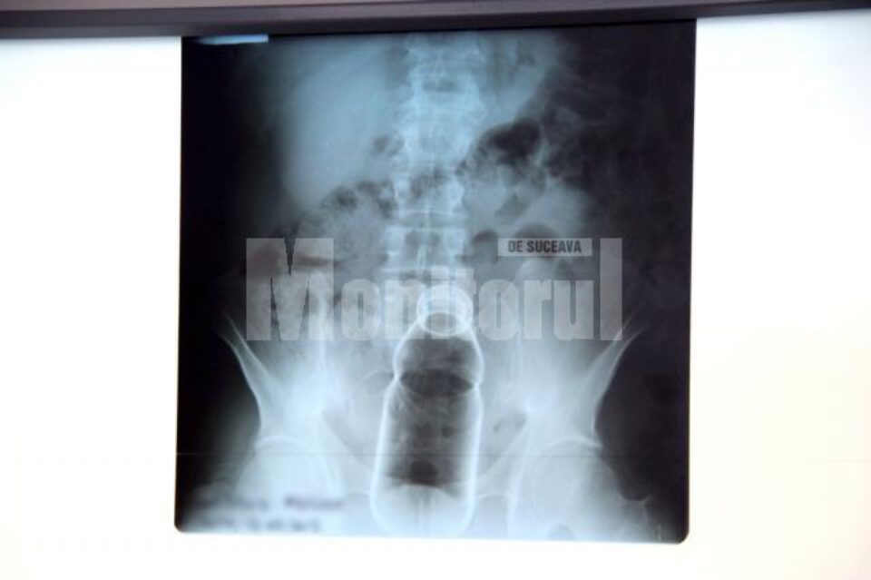 Un botoșănean de 46 de ani a ajuns la Spitalul Județean Suceava după ce și-a băgat o sticlă în anus