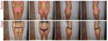 Fotografiile prezentate arată evoluția clienților Endermo Clinic înainte și după folosirea LPG Cellu M6. Sunt fotografii 100% reale, din baza de date a clinicii de pe strada Mărășești.