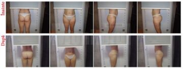 Fotografiile prezentate arată evoluția clienților Endermo Clinic înainte și după folosirea LPG Cellu M6. Sunt fotografii 100% reale, din baza de date a clinicii de pe strada Mărășești.