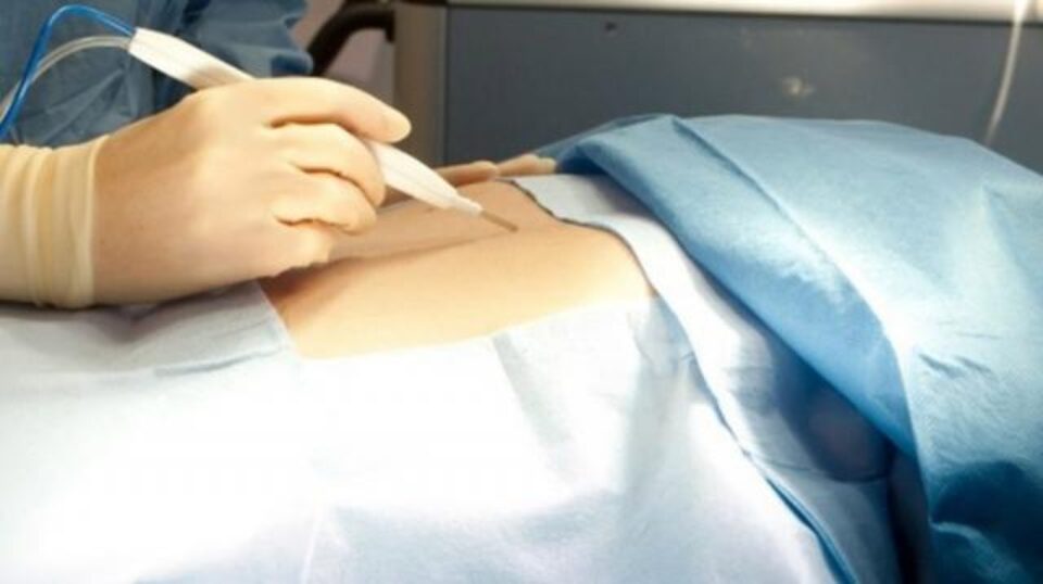 Un nou tip de bisturiu poate să facă diferența între un țesut sănătos și o tumoare canceroasă Un nou tip de bisturiu poate să facă diferența între un țesut sănătos și o tumoare canceroasă