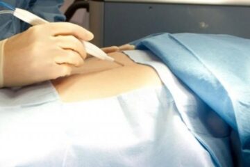 Un nou tip de bisturiu poate să facă diferența între un țesut sănătos și o tumoare canceroasă