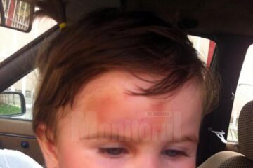 Fotografiile au fost făcute la patru zile de la incident, după ce micuței i-au fost puse comprese și foi de varză