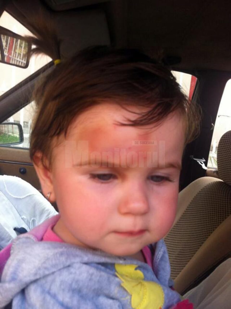 Fotografiile au fost făcute la patru zile de la incident, după ce micuței i-au fost puse comprese și foi de varză Fotografiile au fost făcute la patru zile de la incident, după ce micuței i-au fost puse comprese și foi de varză