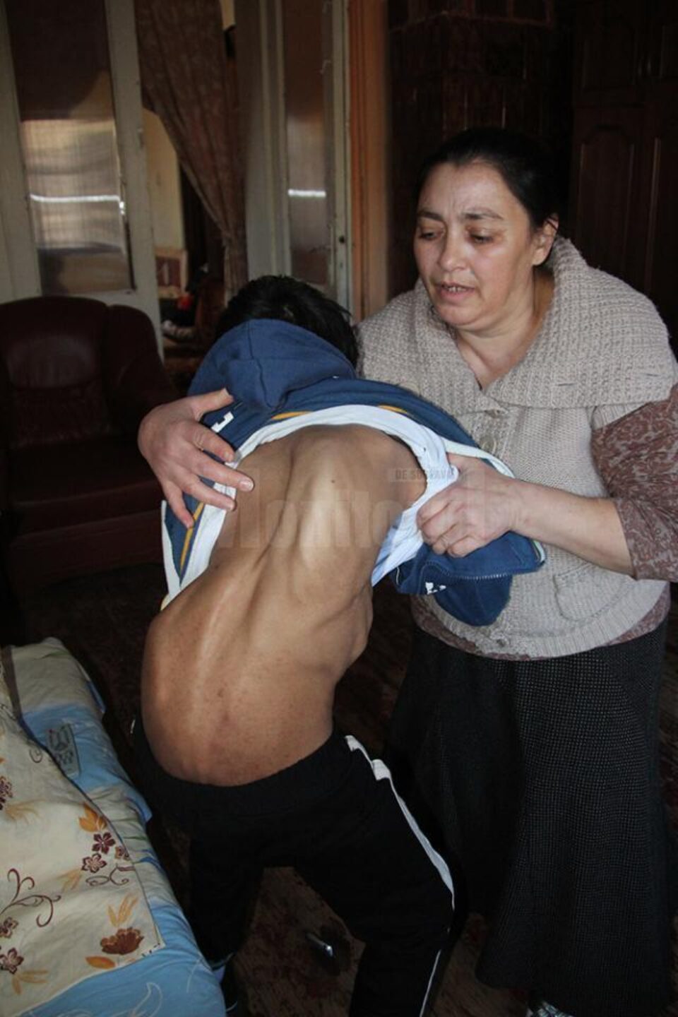 Romario Florin Matei, din municipiul Suceava, în vârstă de 16 ani, suferă de scolioză cervicală-dorsală severă, retard psihomotor sever și autism