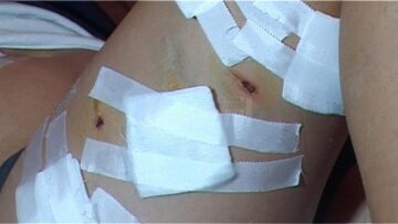 Copilul a fost diagnosticat cu „plăgi multiple membru inferior stâng, coapsa dreaptă și perete abdominal”