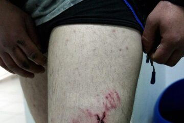 Victima are mai multe plăgi mușcate