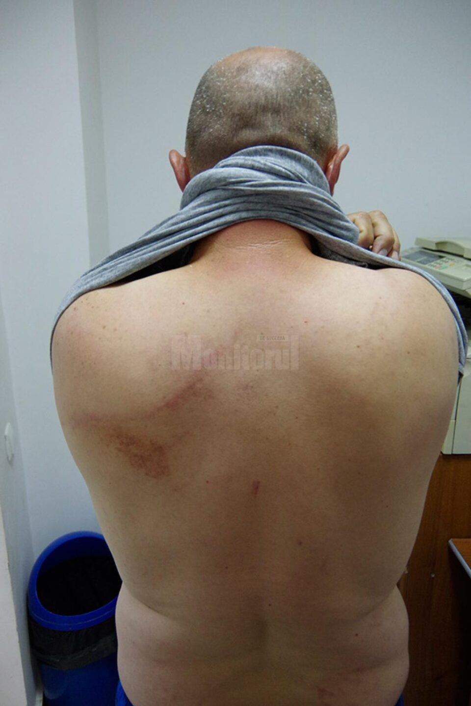 Valerică Chiriloaia arată că a rămas cu mai multe urme ale agresiunii și declară că va face plângere penală împotriva agresorilor Valerică Chiriloaia arată că a rămas cu mai multe urme ale agresiunii și declară că va face plângere penală împotriva agresorilor
