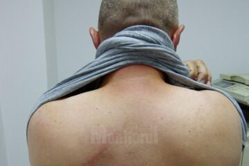 Valerică Chiriloaia arată că a rămas cu mai multe urme ale agresiunii și declară că va face plângere penală împotriva agresorilor