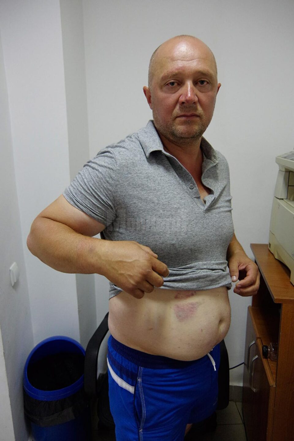 Valerică Chiriloaia arată că a rămas cu mai multe urme ale agresiunii și declară că va face plângere penală împotriva agresorilor