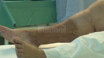 Chirurgii ortopezi suceveni i-au montat, ieri, un genunchi artificial unei femei din Botoșani