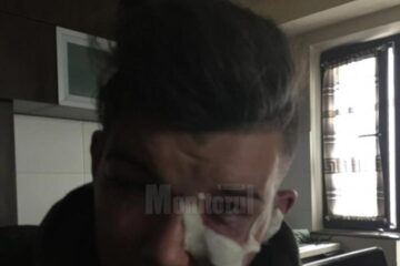 În urma bătăii, Eduard Dura a ajuns la Urgențele Spitalului Județean, cu ochii umflați și multiple vânătăi și urme de lovituri, în principal în zona feței