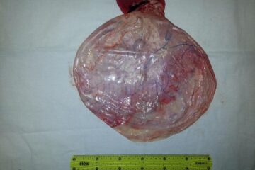 Chistul de 12 kg operat de dr. Diaconu