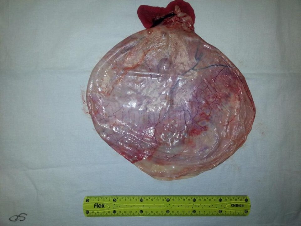 Chistul de 12 kg operat de dr. Diaconu