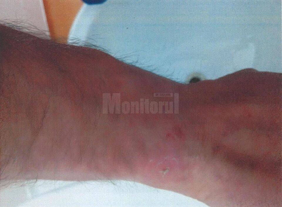 Pentru rănile suferite, Vladimir Prisacă a primit un certificat medico-legal în care se menționează că are nevoie de 3-4 zile de îngrijiri medicale pentru vindecare