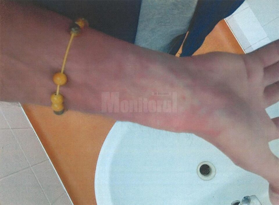 Pentru rănile suferite, Vladimir Prisacă a primit un certificat medico-legal în care se menționează că are nevoie de 3-4 zile de îngrijiri medicale pentru vindecare