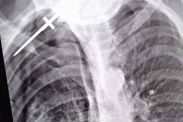 Radiografia bărbatului înjunghiat