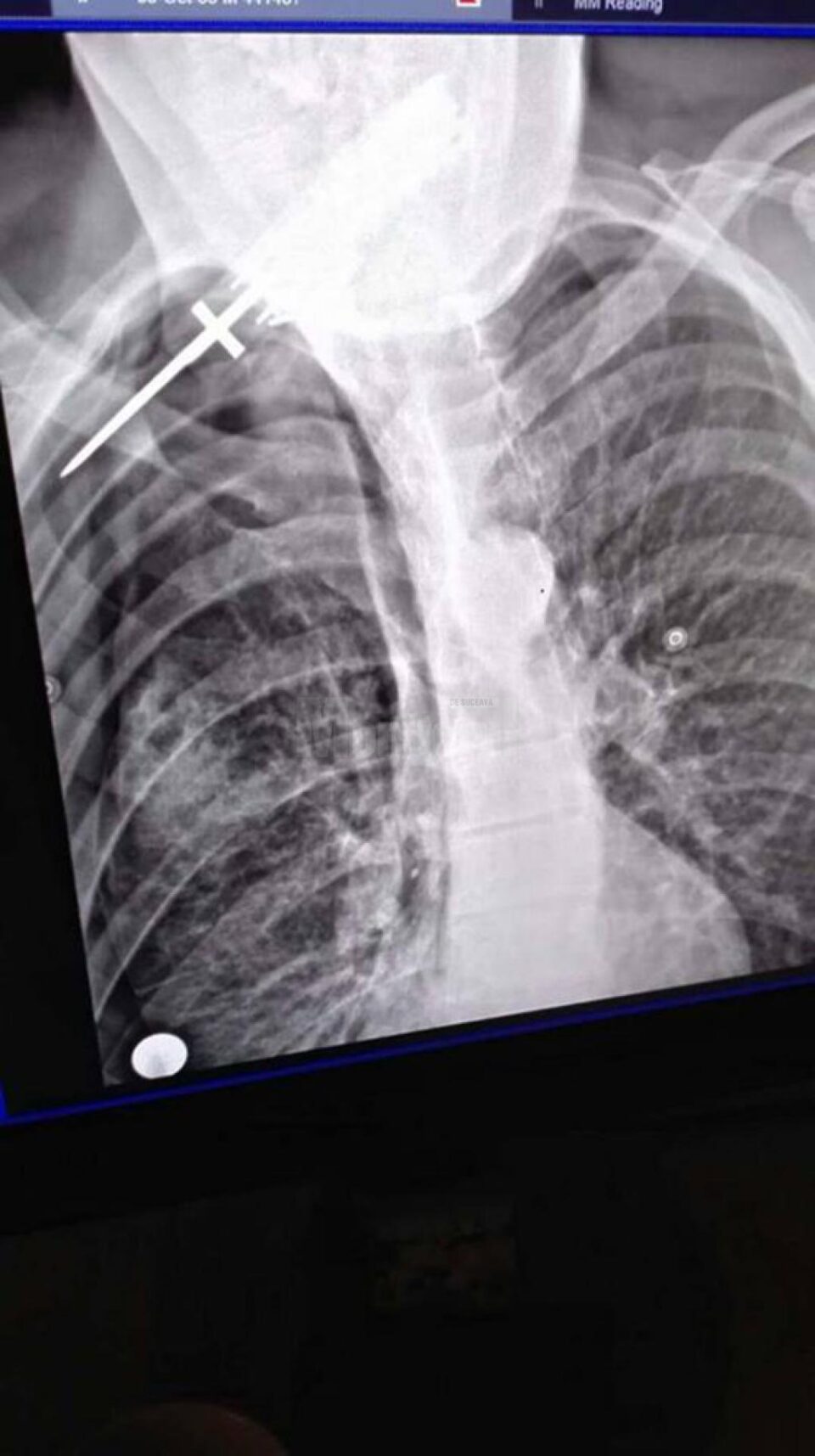 Radiografia bărbatului înjunghiat Radiografia bărbatului înjunghiat