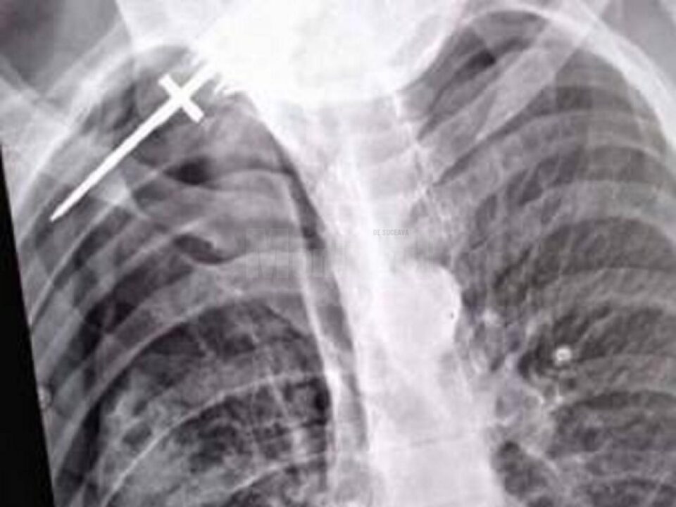 Radiografia bărbatului înjunghiat